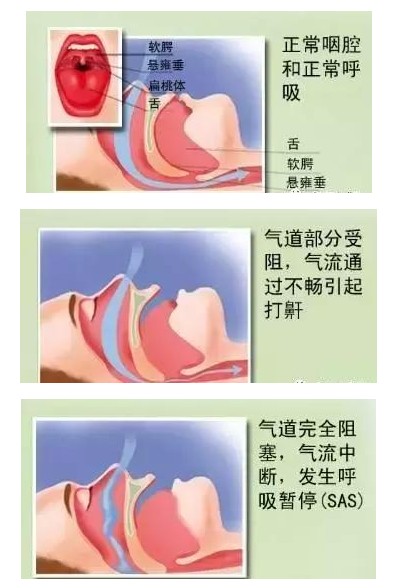 呼吸機(jī)可以完全治愈睡眠呼吸暫停嗎？