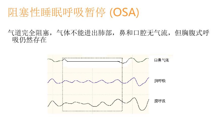 睡眠呼吸暫停